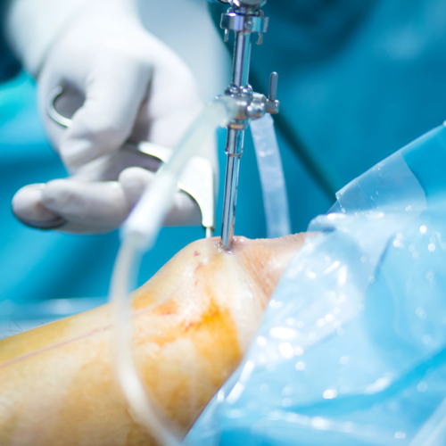 knee replacement surgeon Punawale